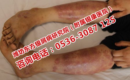 濟(jì)南治牛皮癬哪家醫(yī)院理想