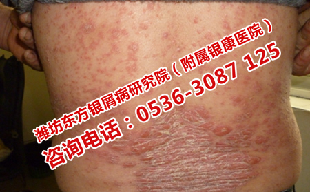 重癥牛皮癬如何進行護理