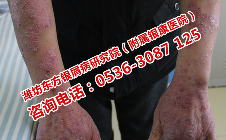 上哪里治療復發的牛皮癬