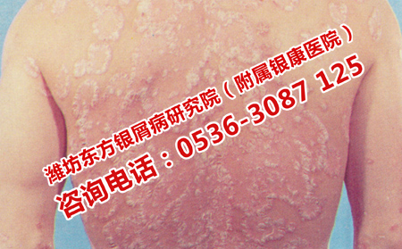 中醫(yī)治療濟南牛皮癬