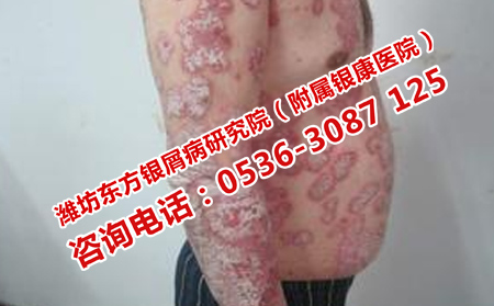 牛皮癬患者的日常護(hù)理