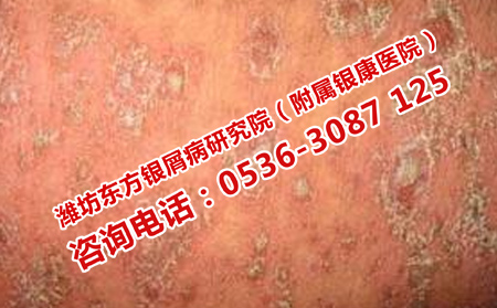 頑固牛皮癬怎么進(jìn)行治療