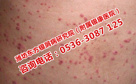 如何預防女性牛皮癬復發