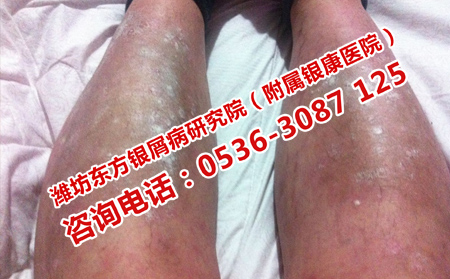 濟(jì)南專門治療男性牛皮癬的醫(yī)院