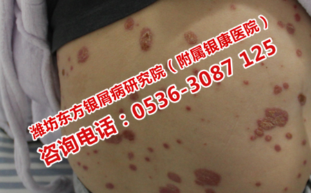 治療牛皮癬便宜的醫院