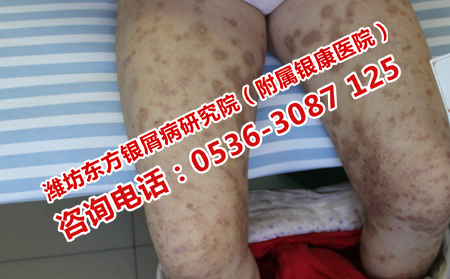 中醫(yī)治療牛皮癬的有效方法