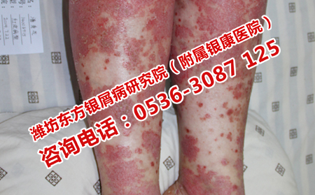 銀屑病恢復(fù)之后護(hù)理