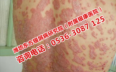 如何預防紅皮型牛皮癬