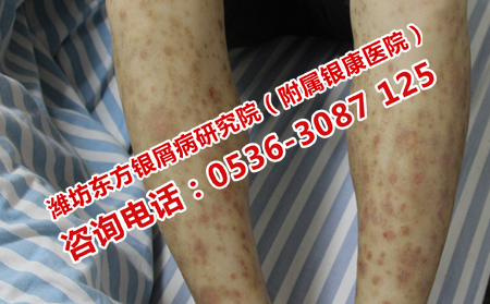 牛皮癬治療費用問題