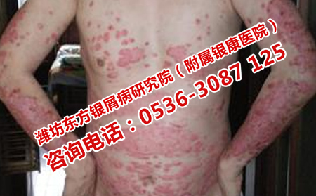 銀屑病復發了去哪里治