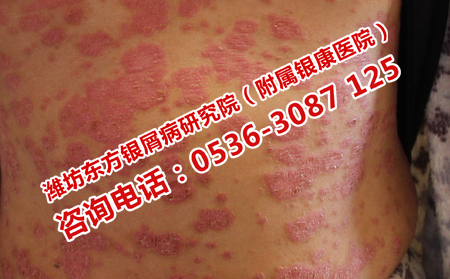 濟南治銀屑病的價格