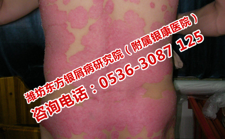長清治紅皮型銀屑病的醫院