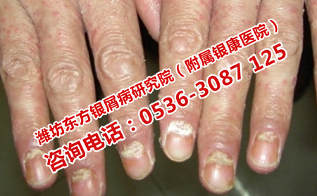 鋼城治銀屑病醫院