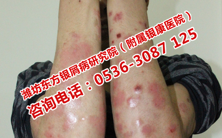 為何銀屑病會復(fù)發(fā)