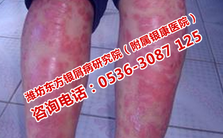 如何預防銀屑病加重呢