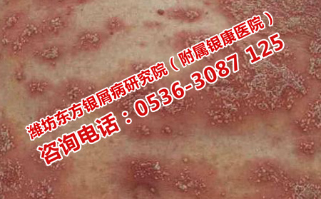 設(shè)么樣的醫(yī)院治銀屑病有效