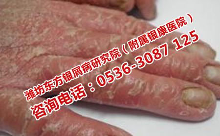 濟南銀屑病醫(yī)院電話